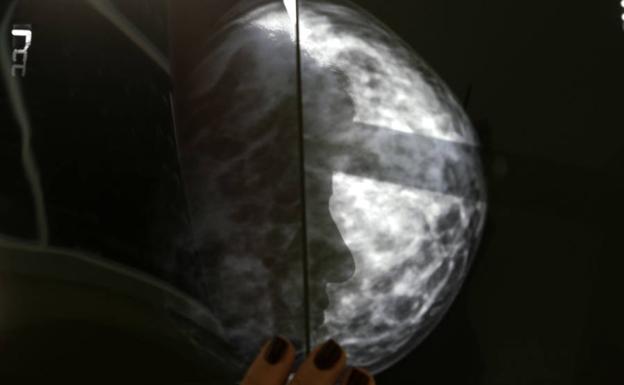 Mamografía./Reuters